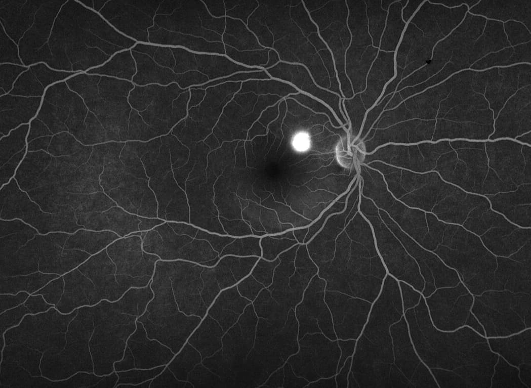 central serous chorioretinopathy treatment